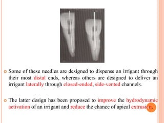  Some of these needles are designed to dispense an irrigant through
their most distal ends, whereas others are designed to deliver an
irrigant laterally through closed-ended, side-vented channels.
 The latter design has been proposed to improve the hydrodynamic
activation of an irrigant and reduce the chance of apical extrusion.5
 