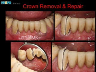 Crown Removal & Repair
 