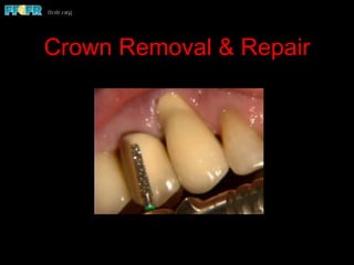 Crown Removal & Repair
 