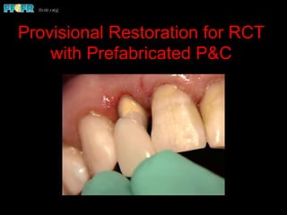 Provisional Restoration for RCT
with Prefabricated P&C
 