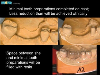 Minimal tooth preparations completed on cast;
Less reduction than will be achieved clinically
Space between shell
and minimal tooth
preparations will be
filled with resin
 