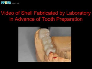 Video of Shell Fabricated by Laboratory
in Advance of Tooth Preparation
 
