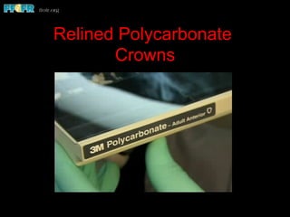 Relined Polycarbonate
Crowns
 