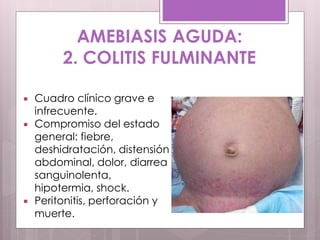 AMEBIASIS AGUDA:
2. COLITIS FULMINANTE
 Cuadro clínico grave e
infrecuente.
 Compromiso del estado
general: fiebre,
deshidratación, distensión
abdominal, dolor, diarrea
sanguinolenta,
hipotermia, shock.
 Peritonitis, perforación y
muerte.
 