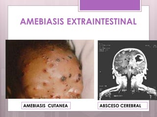 AMEBIASIS EXTRAINTESTINAL
ABSCESO CEREBRALAMEBIASIS CUTANEA
 