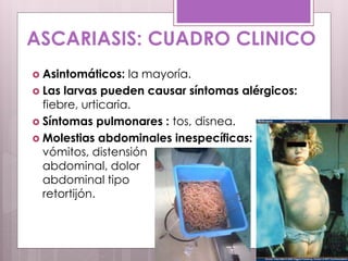 ASCARIASIS: CUADRO CLINICO
 Asintomáticos: la mayoría.
 Las larvas pueden causar síntomas alérgicos:
fiebre, urticaria.
 Síntomas pulmonares : tos, disnea.
 Molestias abdominales inespecíficas:
vómitos, distensión
abdominal, dolor
abdominal tipo
retortijón.
 