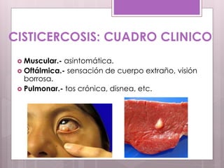 CISTICERCOSIS: CUADRO CLINICO
 Muscular.- asintomática.
 Oftálmica.- sensación de cuerpo extraño, visión
borrosa.
 Pulmonar.- tos crónica, disnea, etc.
 