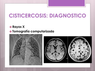 CISTICERCOSIS: DIAGNOSTICO
 Rayos X
 Tomografía computarizada
 