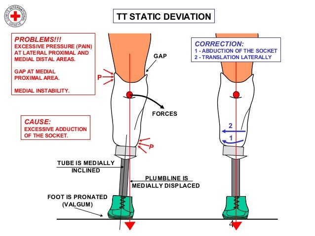 diagram for translation Static Transtibial Alignment diagram for translation Static Transtibial Alignment