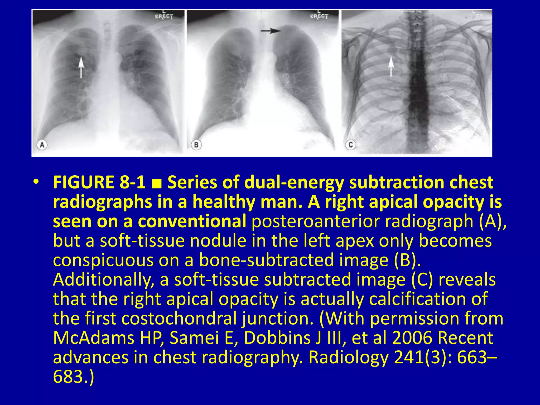 8-Techniques-in-Thoracic-