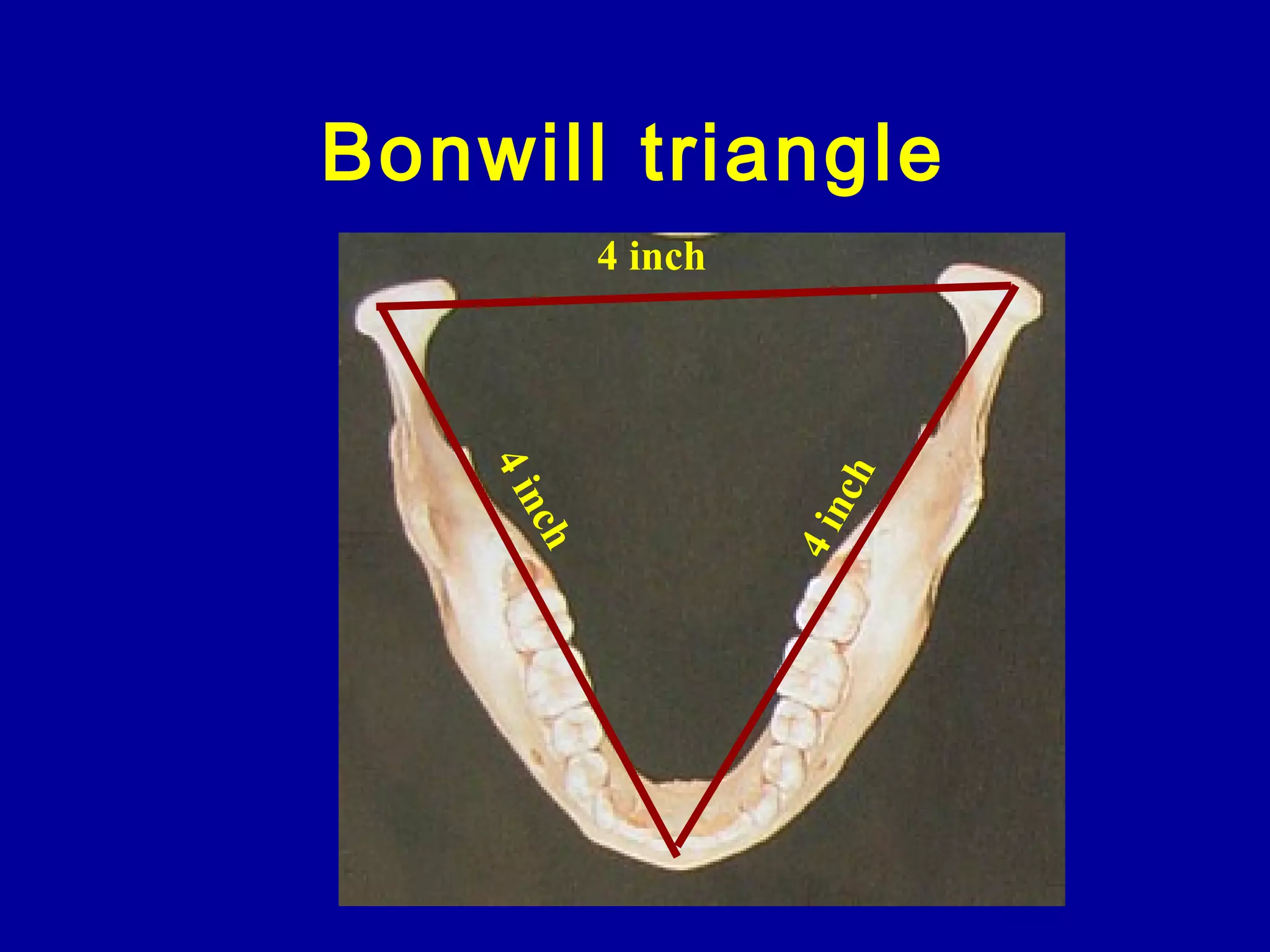 Bonwill triangle
4inch
4inch
4 inch
 