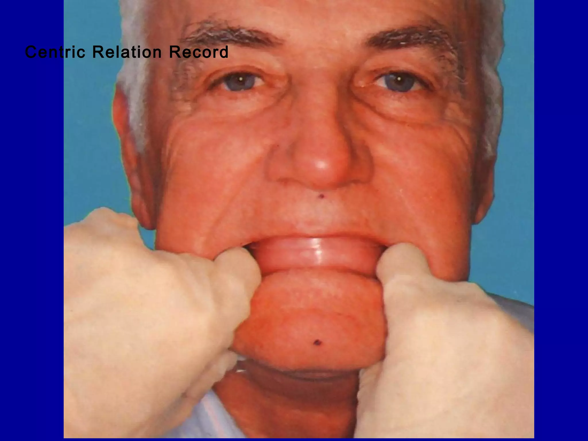 Centric Relation Record
 