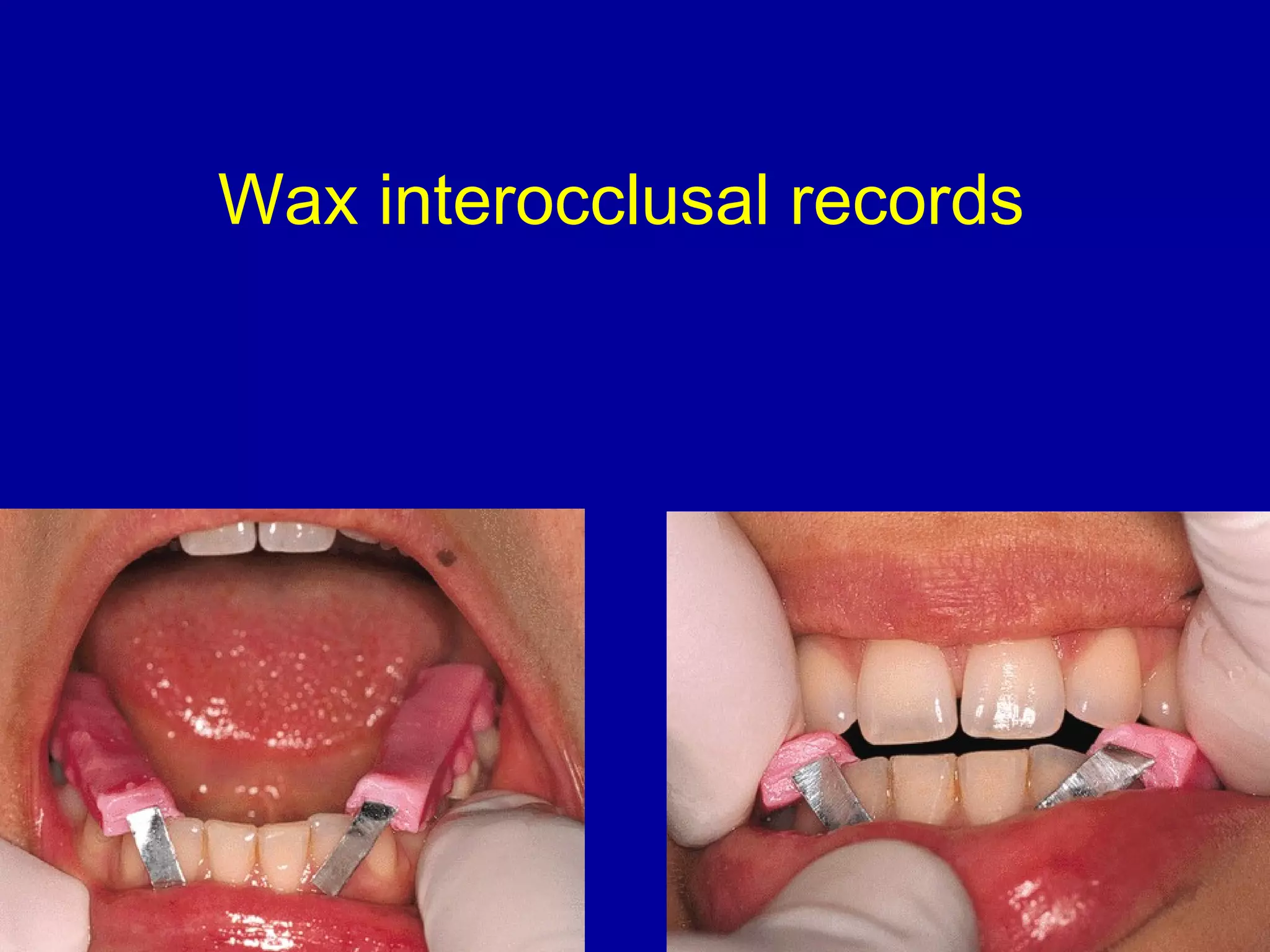 Wax interocclusal records
 