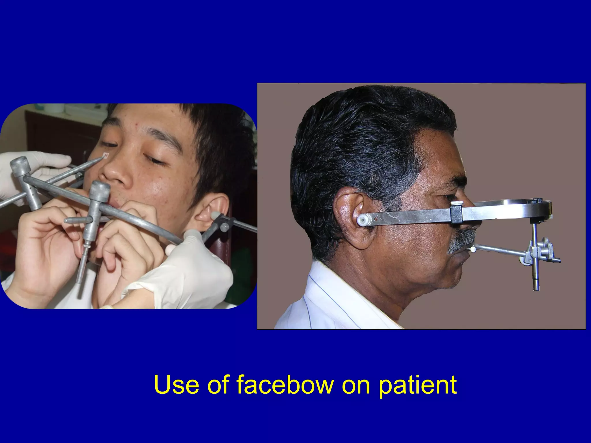 Use of facebow on patient
 