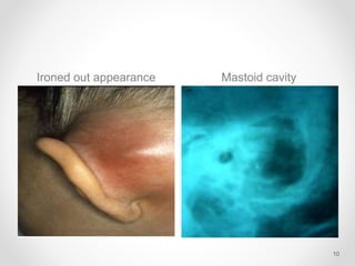 Ironed out appearance Mastoid cavity
10
 