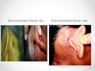 Sub-periosteal fistula: dry Sub-periosteal fistula: wet
26
 
