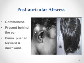 Post-auricular Abscess
• Commonest.
• Present behind
the ear.
• Pinna pushed
forward &
downward.
28
 