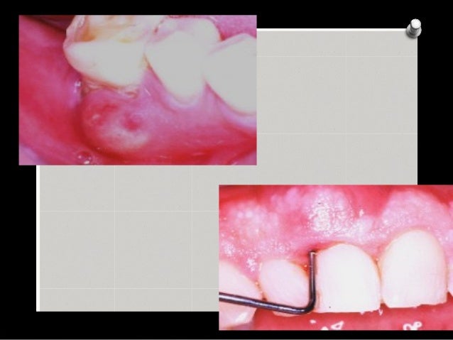 PERIODONTAL ABSCESS
