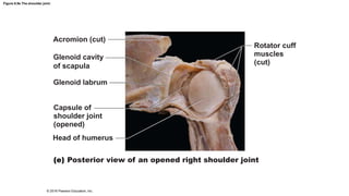 Figure 8.9e The shoulder joint.
Acromion (cut)
Glenoid cavity
of scapula
Glenoid labrum
Rotator cuff
muscles
(cut)
Capsule of
shoulder joint
(opened)
Head of humerus
Posterior view of an opened right shoulder joint
© 2016 Pearson Education, Inc.
 