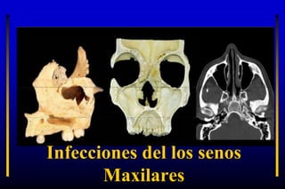 Infecciones del los senos
Maxilares
 