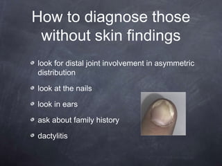look for distal joint involvement in asymmetric
distribution
look at the nails
look in ears
ask about family history
dactylitis
How to diagnose those
without skin findings
 