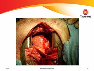 Resuscitative Thoracotomy 2016 2212/27/16
 