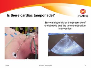 Resuscitative Thoracotomy 2016 7
Is there cardiac tamponade?Is there cardiac tamponade?
Survival depends on the presence of
tamponade and the time to operative
intervention
12/27/16
 