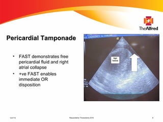 Resuscitative Thoracotomy 2016 8
Pericardial TamponadePericardial Tamponade
• FAST demonstrates free
pericardial fluid and right
atrial collapse
• +ve FAST enables
immediate OR
disposition
12/27/16
 
