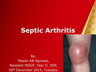Septic Arthritis
By:
Pawan KB Agrawal,
Resident MDGP, Year II, IOM,
30th December 2014, Tuesday.
 