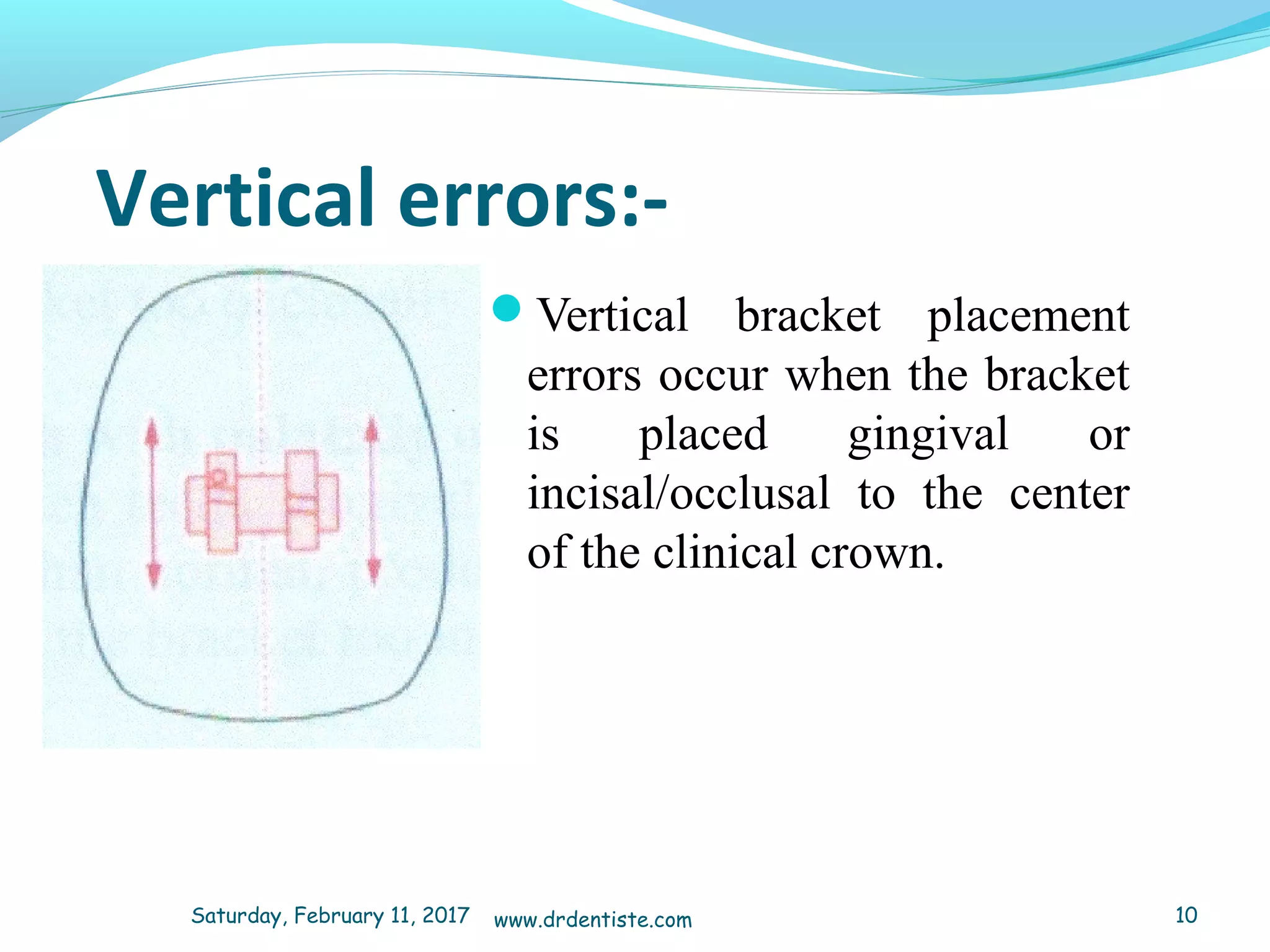 Vertical errors:­
Vertical bracket placement
errors occur when the bracket
is placed gingival or
incisal/occlusal to the center
of the clinical crown.
Saturday, February 11, 2017 10www.drdentiste.com
 