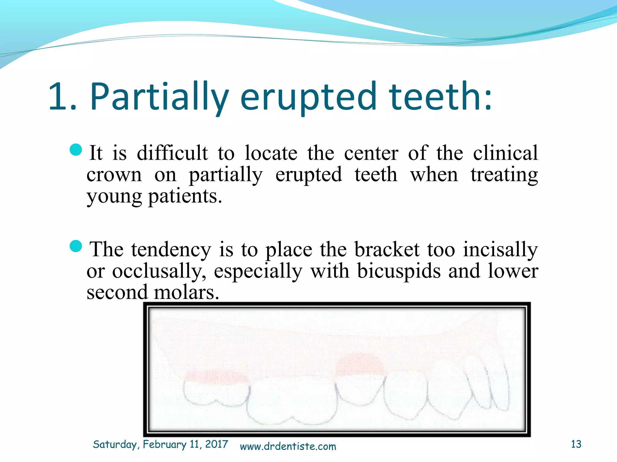 1. Partially erupted teeth:
It is difficult to locate the center of the clinical
crown on partially erupted teeth when treating
young patients.
The tendency is to place the bracket too incisally
or occlusally, especially with bicuspids and lower
second molars.
Saturday, February 11, 2017 13www.drdentiste.com
 