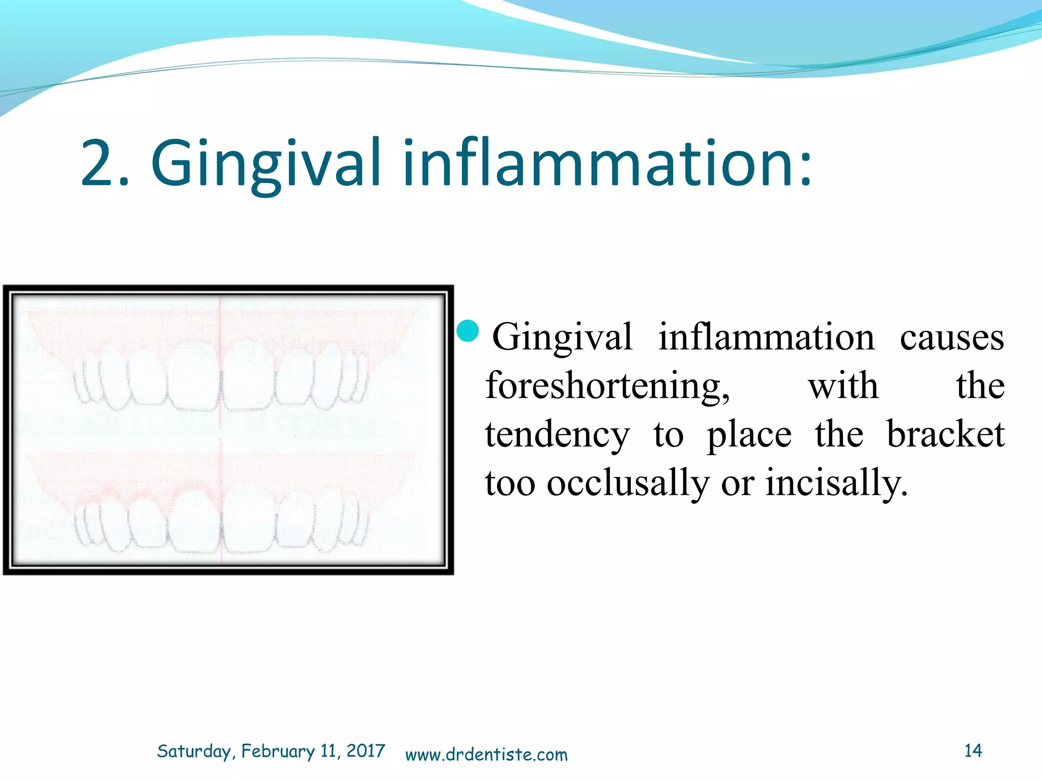 2. Gingival inflammation:
Gingival inflammation causes
foreshortening, with the
tendency to place the bracket
too occlusally or incisally.
Saturday, February 11, 2017 14www.drdentiste.com
 