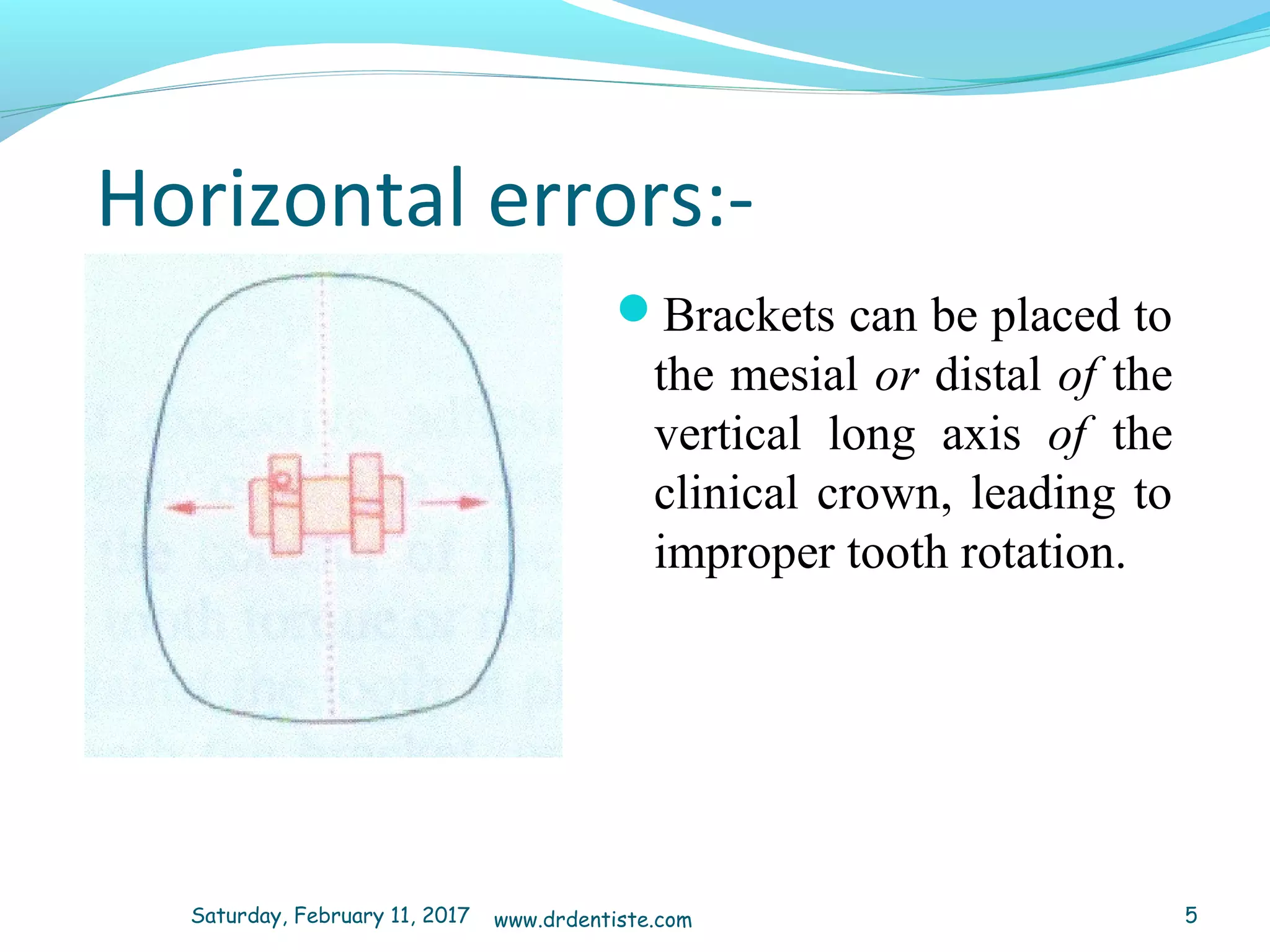 Horizontal errors:­
Brackets can be placed to
the mesial or distal of the
vertical long axis of the
clinical crown, leading to
improper tooth rotation.
Saturday, February 11, 2017 5www.drdentiste.com
 