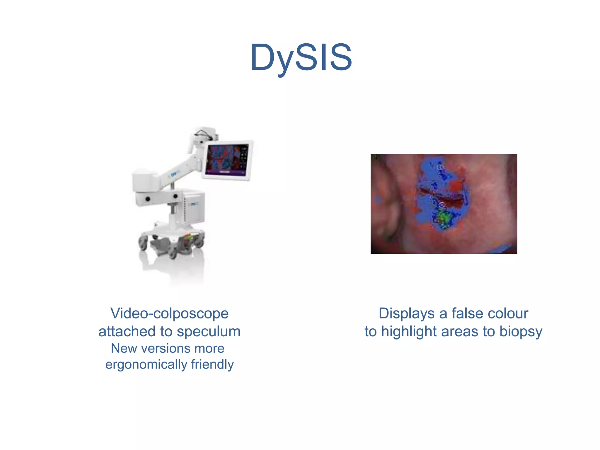 DySIS
Video-colposcope
attached to speculum
New versions more
ergonomically friendly
Displays a false colour
to highlight areas to biopsy
 