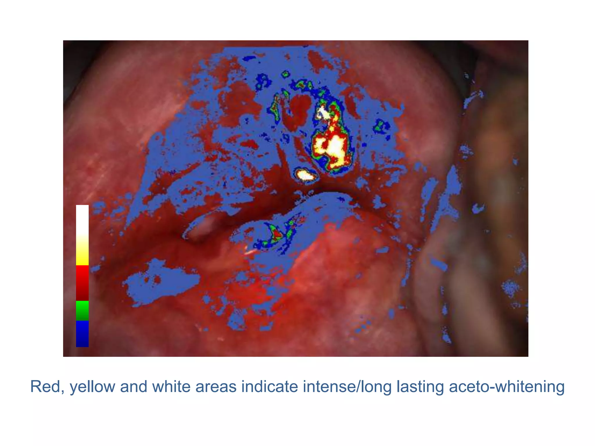 Red, yellow and white areas indicate intense/long lasting aceto-whitening
 