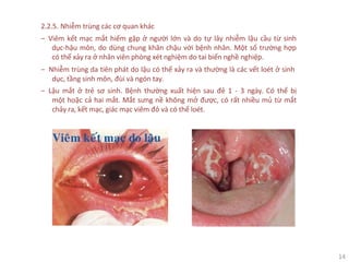 14
2.2.5. Nhiễm trùng các cơ quan khác
‒ Viêm kết mạc mắt hiếm gặp ở người lớn và do tự lây nhiễm lậu cầu từ sinh
dục-hậu môn, do dùng chung khăn chậu với bệnh nhân. Một số trường hợp
có thể xảy ra ở nhân viên phòng xét nghiệm do tai biến nghề nghiệp.
‒ Nhiễm trùng da tiên phát do lậu có thể xảy ra và thường là các vết loét ở sinh
dục, tầng sinh môn, đùi và ngón tay.
‒ Lậu mắt ở trẻ sơ sinh. Bệnh thường xuất hiện sau đẻ 1 - 3 ngày. Có thể bị
một hoặc cả hai mắt. Mắt sưng nề không mở được, có rất nhiều mủ từ mắt
chảy ra, kết mạc, giác mạc viêm đỏ và có thể loét.
 