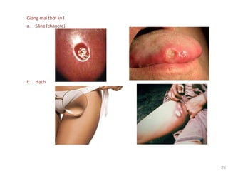 26
Giang mai thời kỳ I
a. Săng (chancre)
b. Hạch
 
