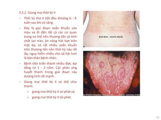 27
3.2.2. Giang mai thời kỳ II
− Thời kỳ thứ II bắt đầu khoảng 6 - 8
tuần sau khi có săng.
− Đây là giai đoạn xoắn khuẩn vào
máu và đi đến tất cả các cơ quan
trong cơ thể nên thương tổn có tính
chất lan tràn, ăn nông hời hợt trên
mặt da, có rất nhiều xoắn khuẩn
trên thương tổn nên thời kỳ này rất
lây, nguy hiểm nhiều cho xã hội hơn
là bản thân bệnh nhân.
− Bệnh tiến triển thành nhiều đợt, dai
dẳng từ 1 - 2 năm. Các phản ứng
huyết thanh trong giai đoạn này
dương tính rất mạnh.
− Giang mai thời kỳ II có thể chia
thành:
+ giang mai thời kỳ II sơ phát và
+ giang mai thời kỳ II tái phát.
 