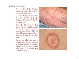 29
b. Giang mai II tái phát
− Thời kỳ này bắt đầu khoảng
tháng thứ 4 đến tháng 12 kể
từ khi mắc giang mai I.
− Các triệu chứng của giang mai
II sơ phát tồn tại trong một
thời gian rồi lại mất đi cho dù
không điều trị.
− Qua một thời gian im lặng
(giang mai kín) lại phát ra các
thương tổn da, niêm mạc. Đó
chính là giang mai thời kỳ II tái
phát. Số lượng thương tổn ít
hơn, nhưng tồn tại dai dẳng
hơn.
− Các thương tổn giang mai II
tái phát: đào ban tái phát với
ít vết hơn, nhưng kích thước
mỗi vết lại to hơn, khu trú vào
một vùng và hay sắp xếp
thành hình vòng.
 