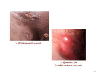 51
5. BỆNH HẠ CAM (Chancroid)
6. BỆNH HỘT XOÀI
(Lymphogranuloma venereum)
 