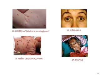 59
11. U MỀM LÂY (Molluscum contagiosum)
12. NHIỄM CYTOMEGALOVIRUS
13. VIÊM GAN B
14. HIV/AIDS
 