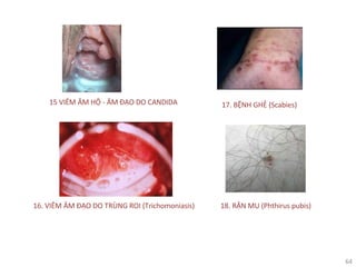 64
15 VIÊM ÂM HỘ - ÂM ĐẠO DO CANDIDA 17. BỆNH GHẺ (Scabies)
16. VIÊM ÂM ĐẠO DO TRÙNG ROI (Trichomoniasis) 18. RẬN MU (Phthirus pubis)
 