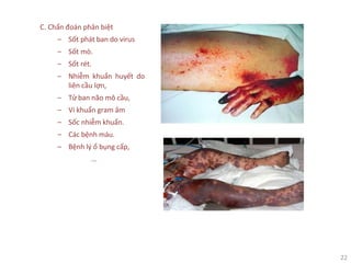 22
C. Chẩn đoán phân biệt
‒ Sốt phát ban do virus
‒ Sốt mò.
‒ Sốt rét.
‒ Nhiễm khuẩn huyết do
liên cầu lợn,
‒ Tử ban não mô cầu,
‒ Vi khuẩn gram âm
‒ Sốc nhiễm khuẩn.
‒ Các bệnh máu.
‒ Bệnh lý ổ bụng cấp,
…
 