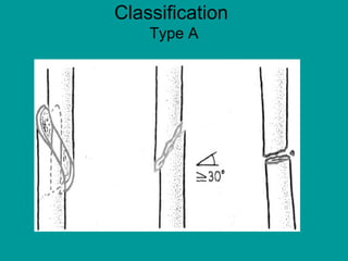 Classification
Type A
 