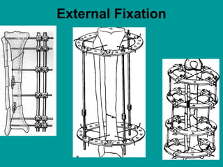 External Fixation
 