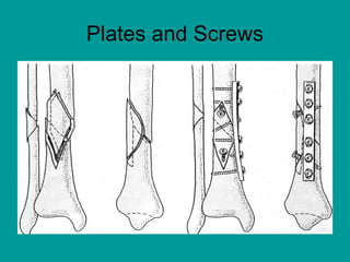 Plates and Screws
 