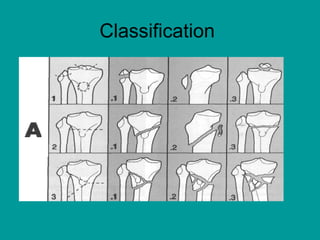 Classification
 
