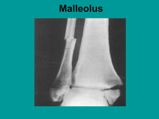 Malleolus
 