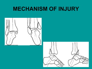 MECHANISM OF INJURY
 
