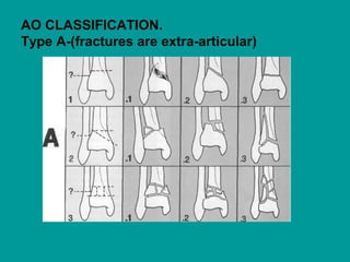 AO CLASSIFICATION.
Type A-(fractures are extra-articular)
 